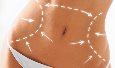 When is the Right Time for a Tummy Tuck?