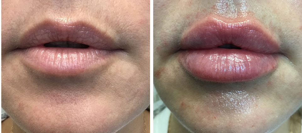 Lip Augmentation  - Brampton Cosmetic Surgery Center & Medical Spa