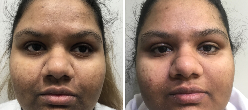 Before & After Me Line Peel Treatments for Hyperpigmentation  - Brampton Cosmetic Surgery Center & Medical Spa