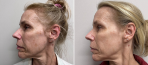 Brampton Cosmetic Photorejuvenation BBL Photofacial Ttreatment<br />Before and After Photo