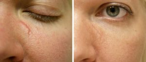 Brampton Cosmetic Profractional Laser Before and After Photo