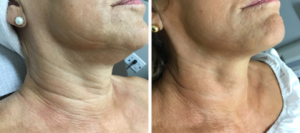 Brampton Cosmetic Medical Spa SkinTyte Before and After Photo