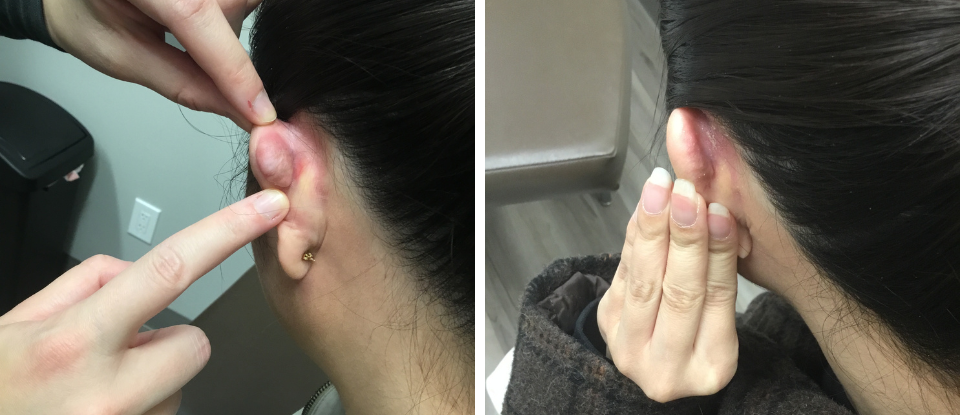 Before & After – Keloid Removal  - Brampton Cosmetic Surgery Center & Medical Spa