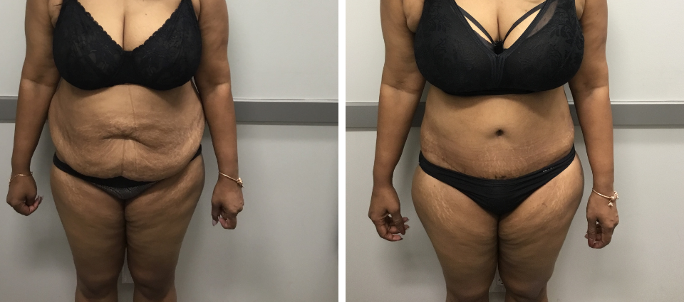 Tummy Tuck Before and After Photos, life after tummy tuck, tummy tuck near  me Abdominoplasty