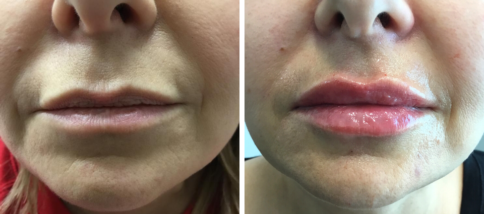 Lip Augmentation  - Brampton Cosmetic Surgery Center & Medical Spa