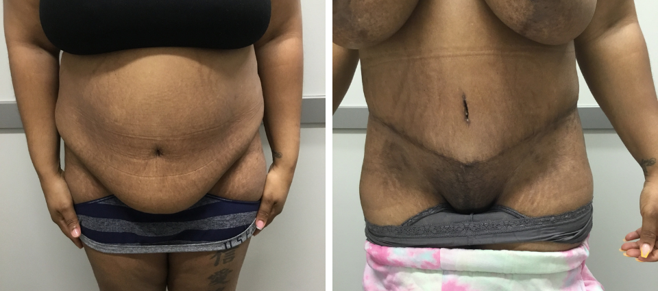 Tummy Tuck Before & Afters, Omaha