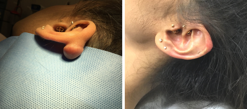 Before & After – Keloid Removal  - Brampton Cosmetic Surgery Center & Medical Spa
