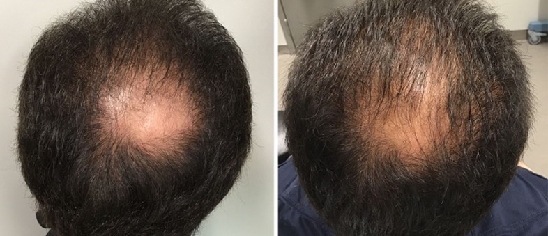 Brampton Cosmetic Microneedling Blog Image 4 - BA