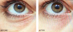 Brampton Cosmetic Microneedling Blog Image 6 - BA