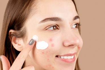 Acne treatment services