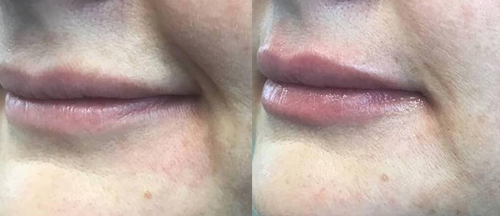 Before & After Lip Injections & Fillers  - Brampton Cosmetic Surgery Center & Medical Spa