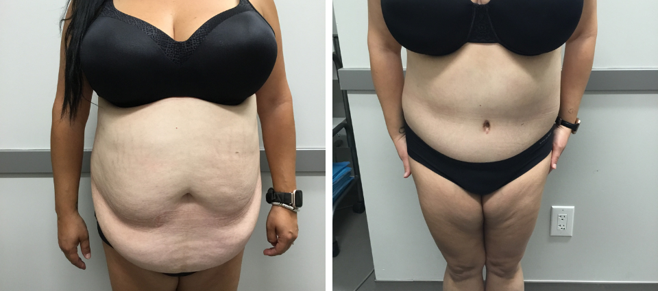 Tummy Tuck Before And After