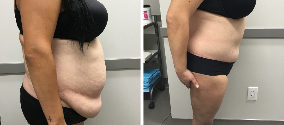 Tummy Tuck Before and After Photos, life after tummy tuck, tummy tuck near  me Abdominoplasty