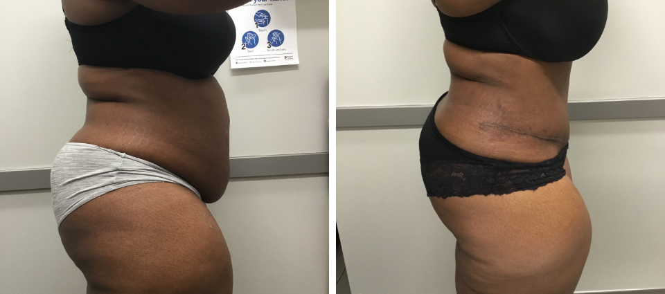 Tummy Tuck Before And After