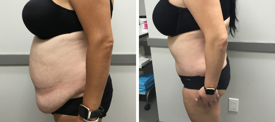 Tummy Tuck Before And After