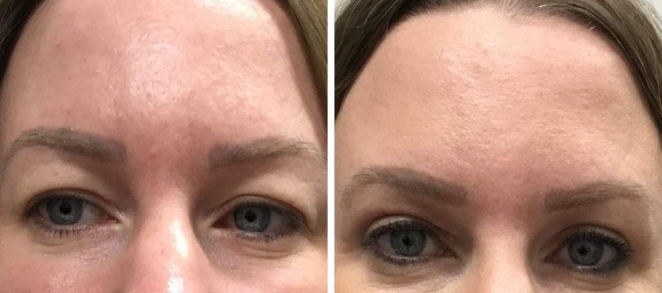 Before & After – Upper Blepharoplasty  - Brampton Cosmetic Surgery Center & Medical Spa