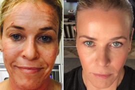 Red Carpet Radiance with a ProFractional Laser Skin Treatment
