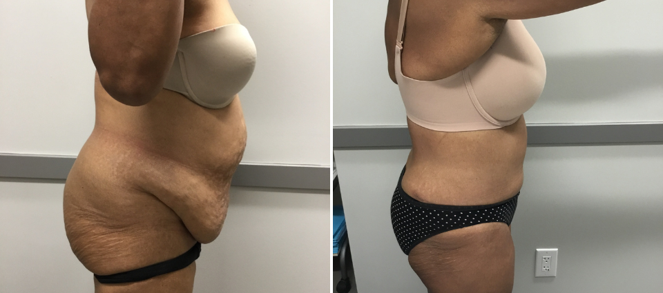 Tummy Tuck (Abdominoplasty) Mississauga Toronto ON