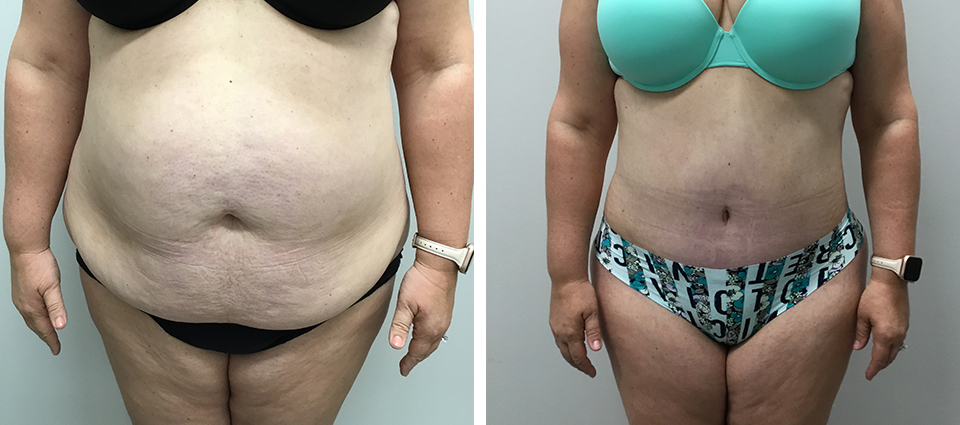 Tummy Tuck Surgery in Brampton, Mississauga & GTA