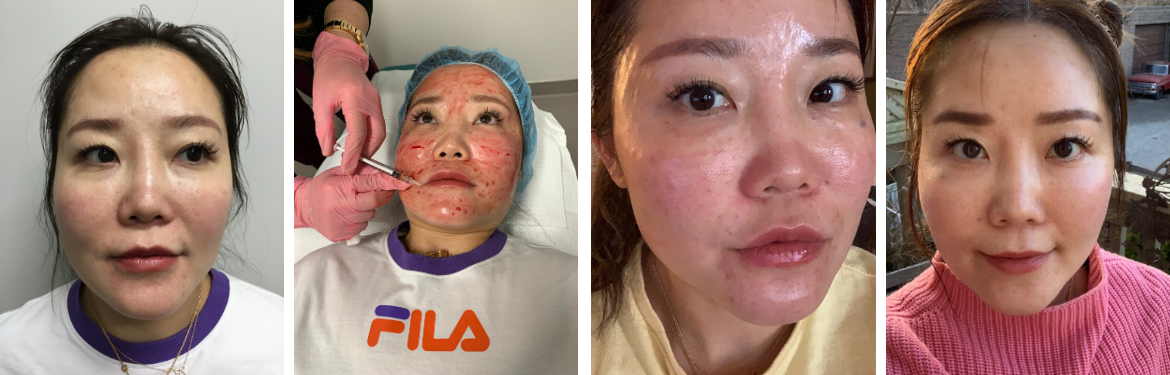 PRP Injection Therapy- Before & After - Brampton Cosmetic Surgery Center & Medical Spa