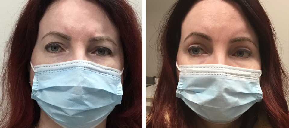 Before & After – Upper Blepharoplasty  - Brampton Cosmetic Surgery Center & Medical Spa