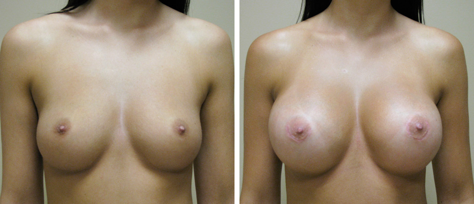 How will my breasts look after explant surgery
