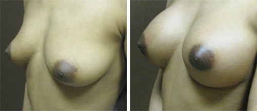 Breast Augmentation  - Brampton Cosmetic Surgery Center & Medical Spa