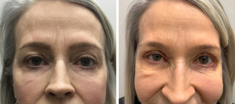 Before & After – Upper Blepharoplasty  - Brampton Cosmetic Surgery Center & Medical Spa