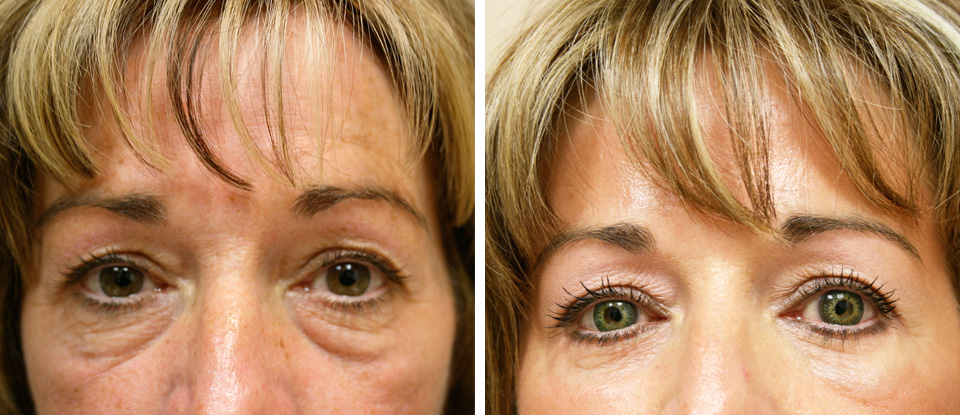 Before & After – Upper Blepharoplasty  - Brampton Cosmetic Surgery Center & Medical Spa