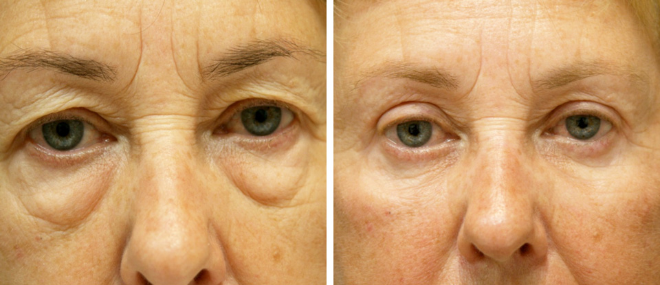 Before & After – Upper Blepharoplasty  - Brampton Cosmetic Surgery Center & Medical Spa