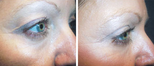 Before & After – Upper Blepharoplasty  - Brampton Cosmetic Surgery Center & Medical Spa