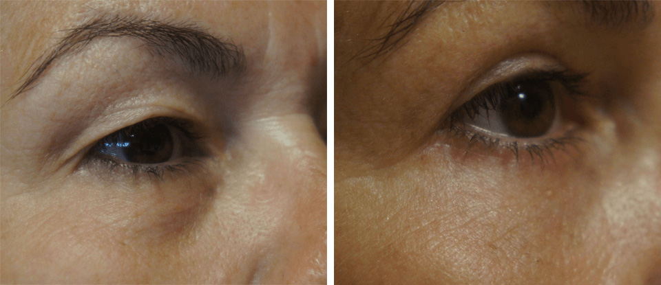 Before & After – Upper Blepharoplasty  - Brampton Cosmetic Surgery Center & Medical Spa