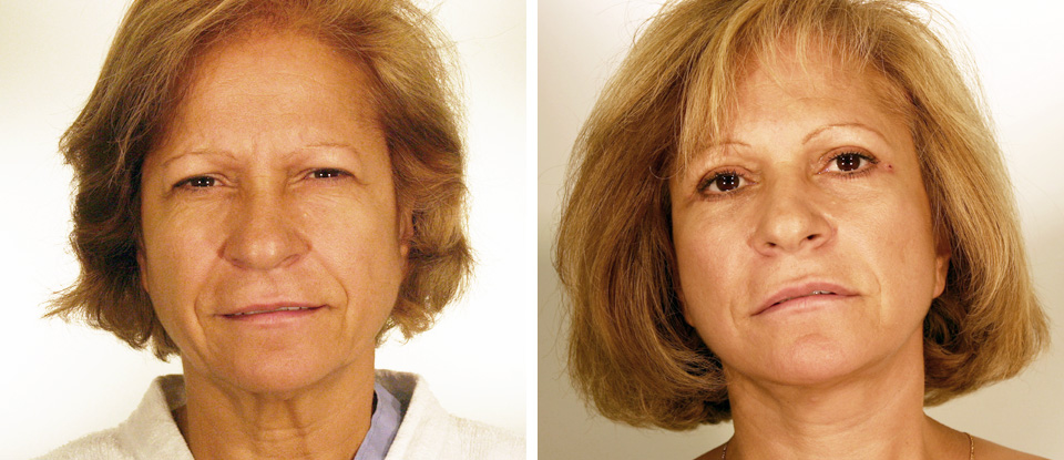 Face Lift  - Brampton Cosmetic Surgery Center & Medical Spa