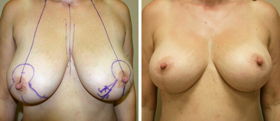 Breast Lift  - Brampton Cosmetic Surgery Center & Medical Spa