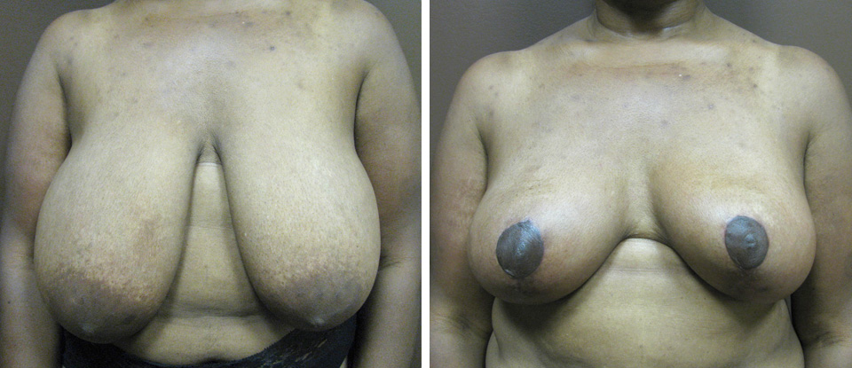 Breast Lift  - Brampton Cosmetic Surgery Center & Medical Spa