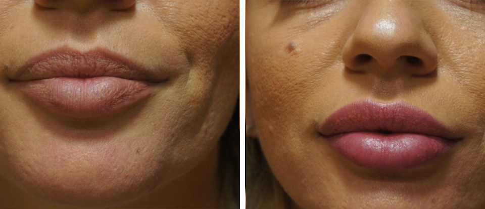 Before & After Lip Injections & Fillers  - Brampton Cosmetic Surgery Center & Medical Spa