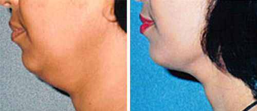 Liposuction - Plastic Surgery, Hamilton, Burlington - Lotus Cosmetic  Surgery Centre and Medispa