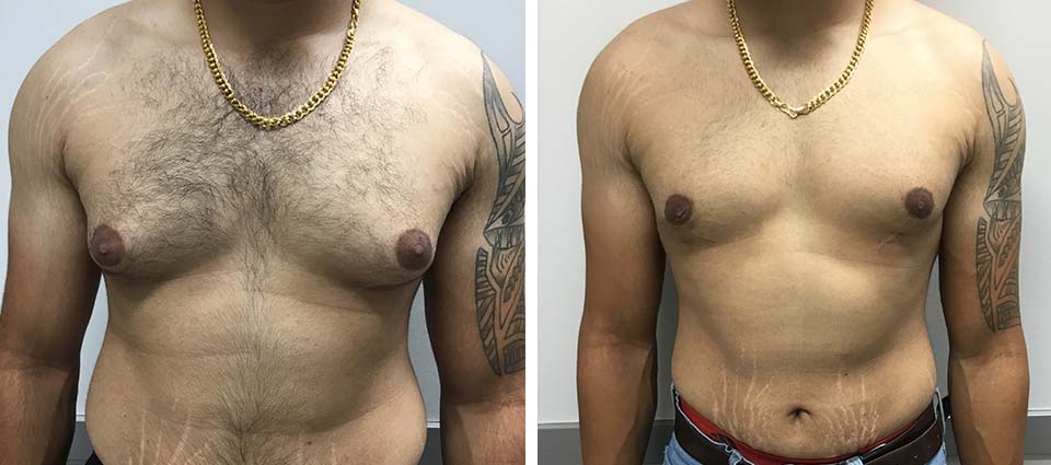 Male Breast Reduction  - Brampton Cosmetic Surgery Center & Medical Spa