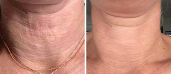 Before & After Microneedling  - Brampton Cosmetic Surgery Center & Medical Spa