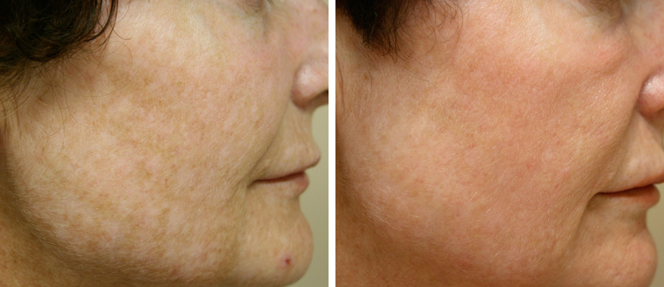 Before & After Laser Skin Treatments  - Brampton Cosmetic Surgery Center & Medical Spa