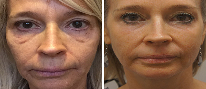 Laser Skin Treatments  - Brampton Cosmetic Surgery Center & Medical Spa