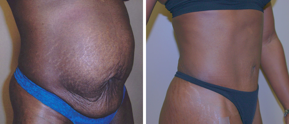 How can you take good before and after photos of your tummy tuck?