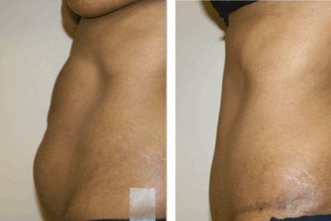 Tummy Tuck Brampton